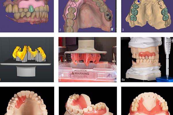 3D-gedruckte Interimsprothesen auf einem hellen Untergrund