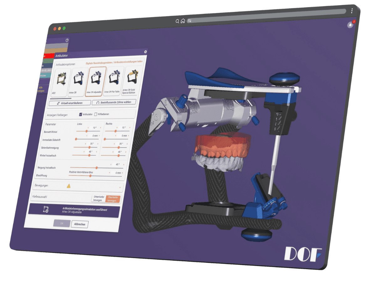 Virtuell artikulierte Aufbissschiene in einer CAD-Software zur Kontrolle der Okklusion