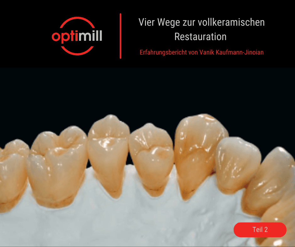Vollkeramische Zahnkronen auf einem Modell zur ästhetischen Finalisierung